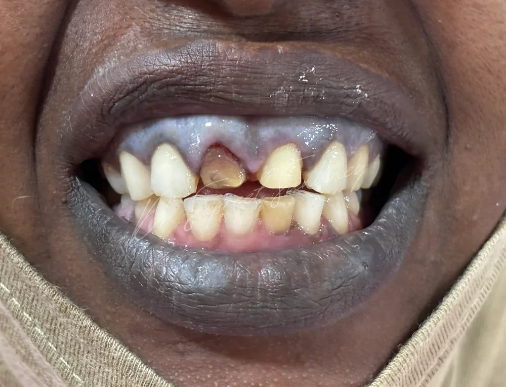 Close-up smile photograph showing fractured and discoloured maxillary anterior teeth